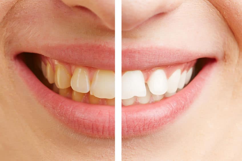 before and after comparison of teeth whitening of a young woman