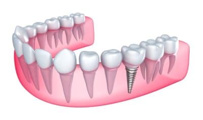 dental implant in the gum - isolated on white